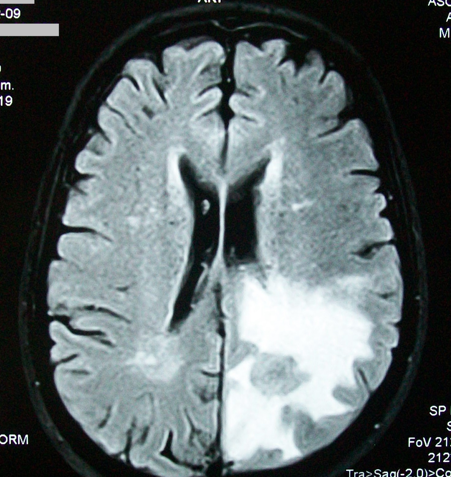 MRI Brain Scan